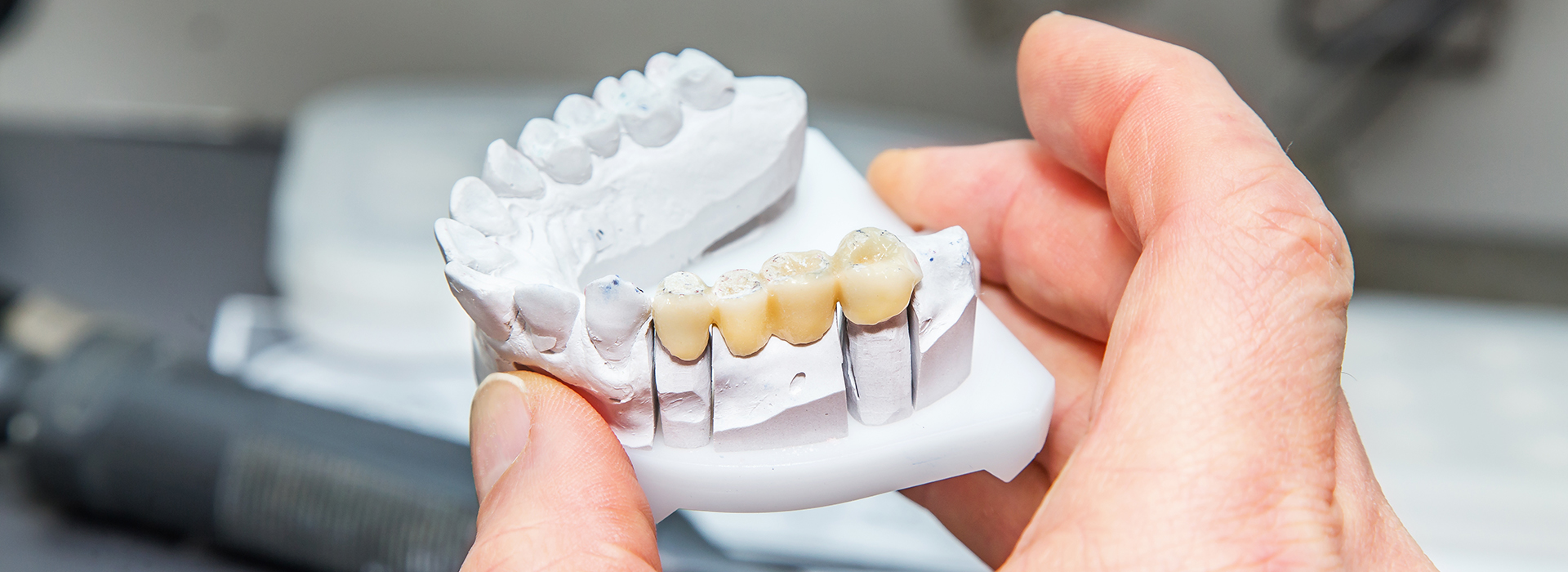 A person is holding a 3D printed model of a dental implant with multiple teeth.