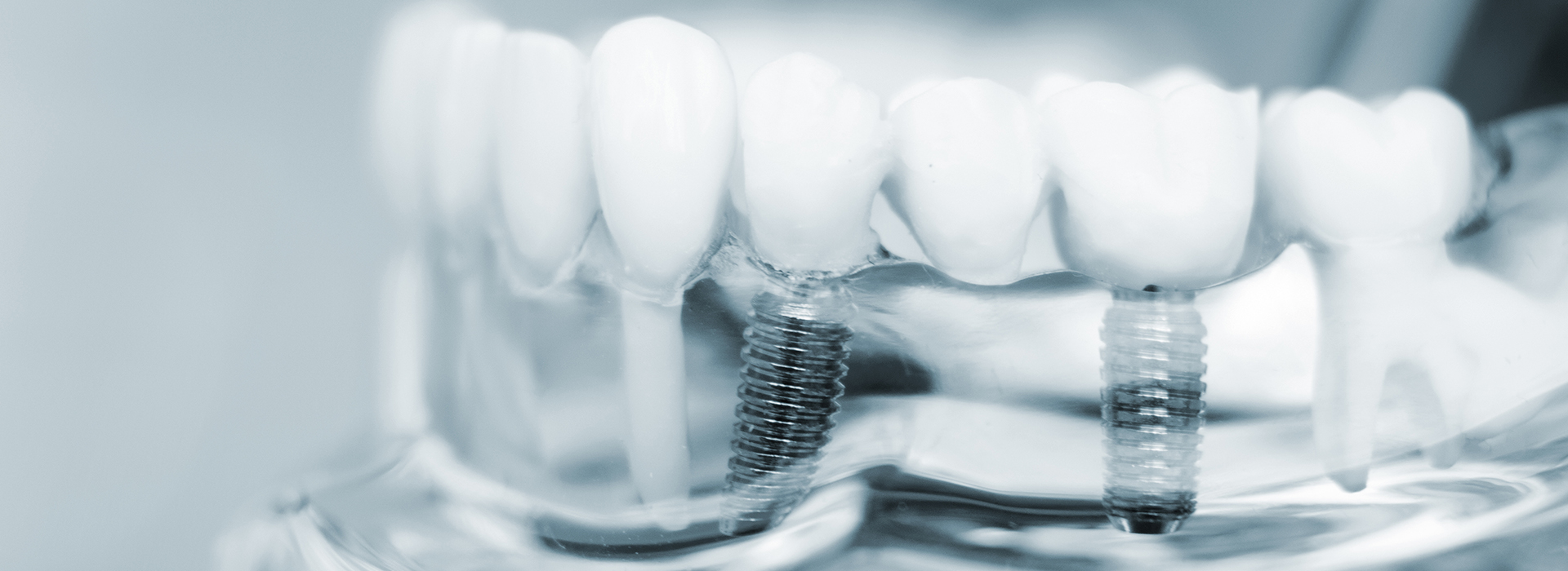 The image shows a close-up of a dental implant, featuring a screw and a porcelain tooth structure against a blurred background.