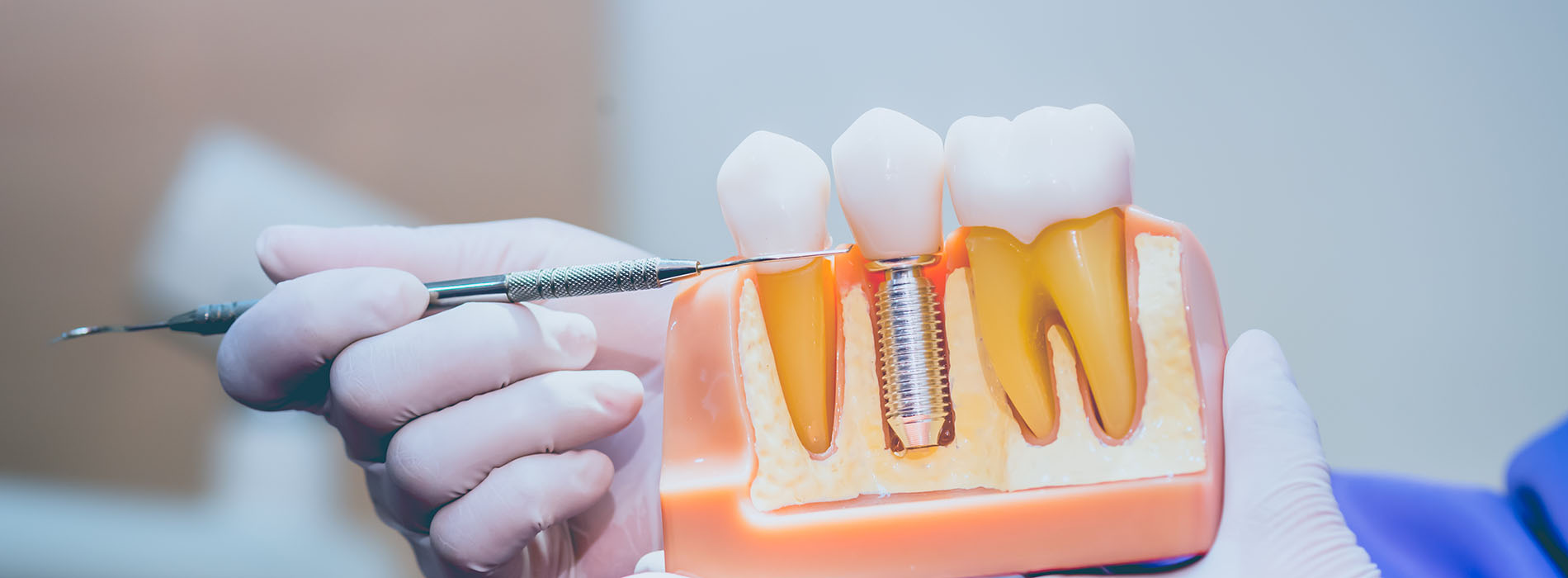 An image of a person holding a dental implant fixture in their hand, with a close-up view of the fixture and a background featuring a medical setting.