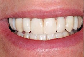 The image shows a close-up of a person s smiling mouth with white teeth, and the individual appears to be middle-aged or older.