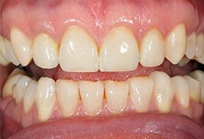 A close-up image of a person s teeth with yellow stains, showcasing the need for dental care.