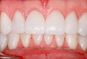 The image shows a close-up view of a person s teeth, which appear to be in the process of being straightened or aligned.