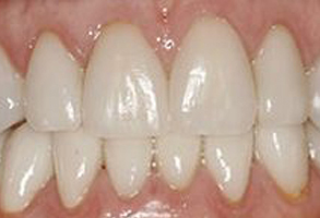 The image shows a close-up of a person s teeth with a focus on the lower front teeth, which appear to have been recently whitened or are naturally white.
