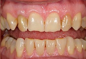 The image shows a close-up of a person s teeth with visible staining and discoloration, emphasizing the need for dental care.