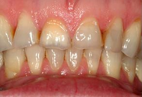 The image displays a close-up view of a person s teeth, showing signs of dental decay and the need for professional oral care.