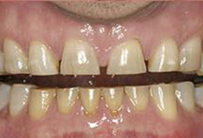 The image shows a close-up of a person s teeth, which appear to be in poor condition with visible decay and staining.